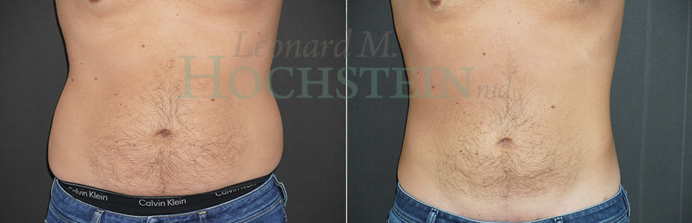 Liposuction Patient