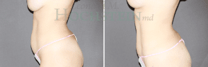 Liposuction Patient 31a