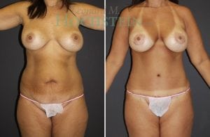 Mommy Makeover Patient