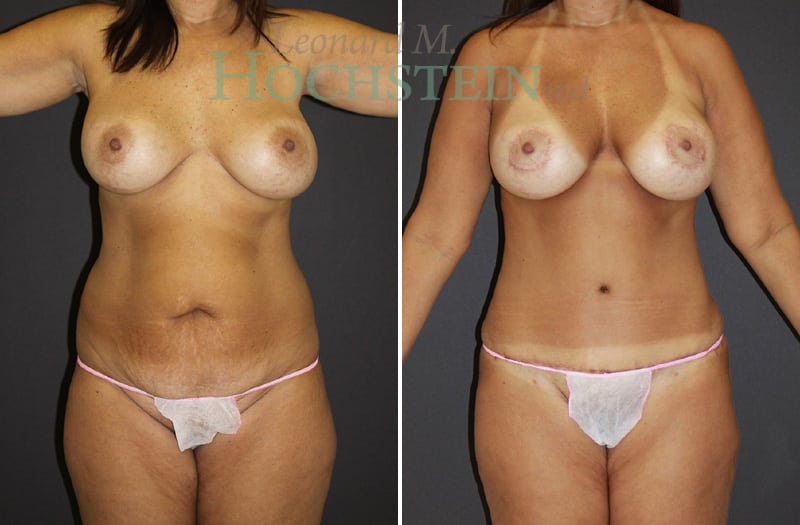 Mommy Makeover Patient