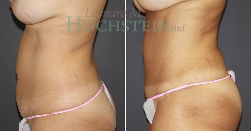 Mommy Makeover Patient