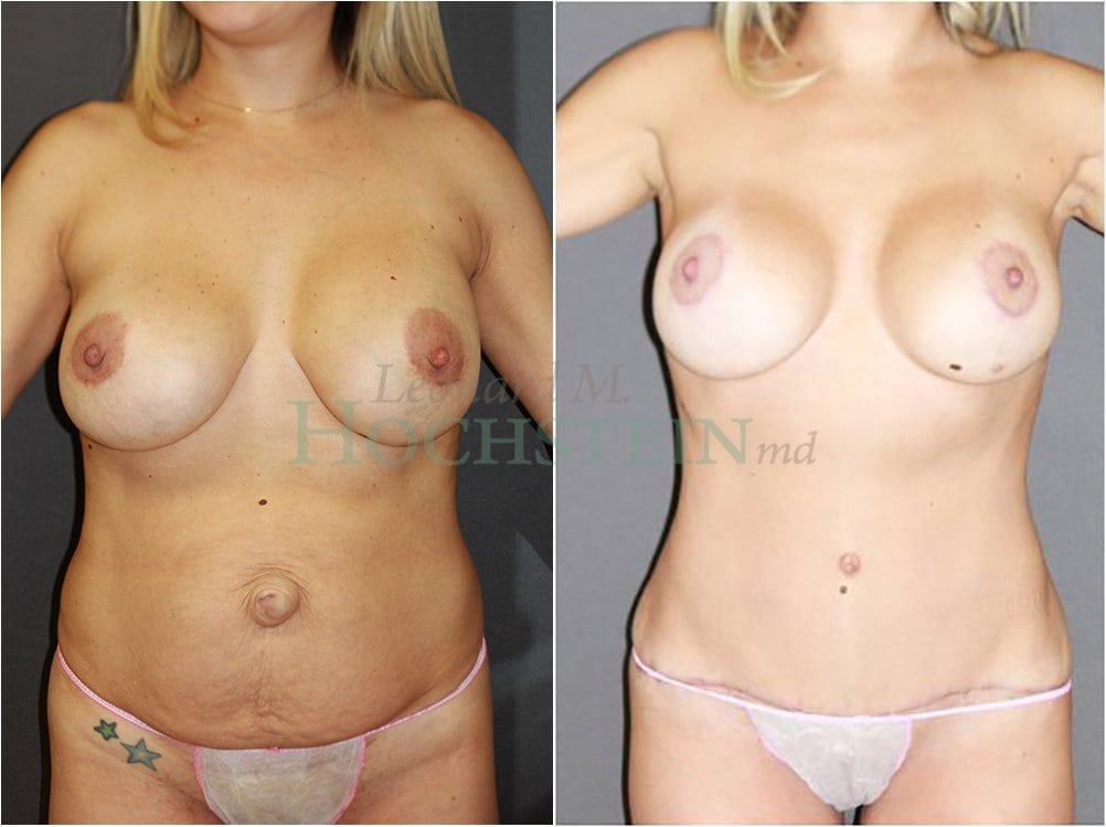 Mommy Makeover Patient