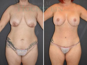 Mommy Makeover Patient 61