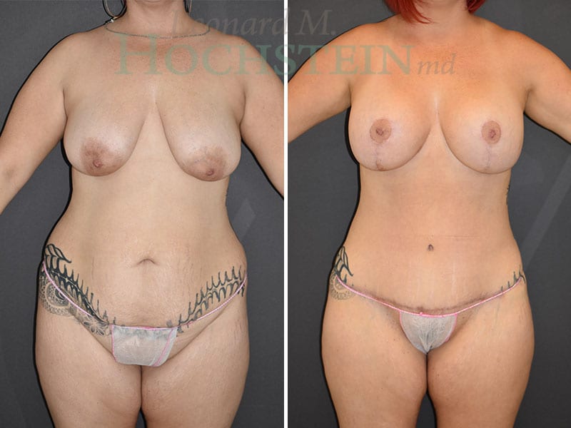 Mommy Makeover Patient