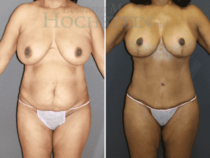 Mommy Makeover Patient 58