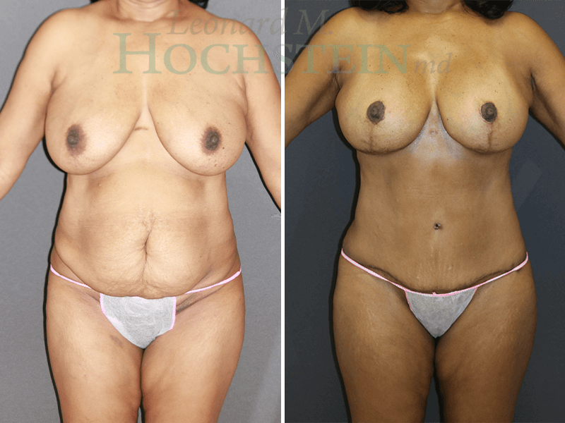 Mommy Makeover Patient