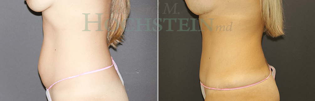 Mommy Makeover Patient