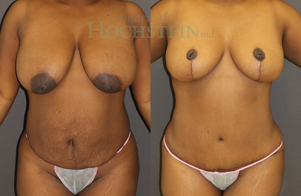 Mommy Makeover Patient