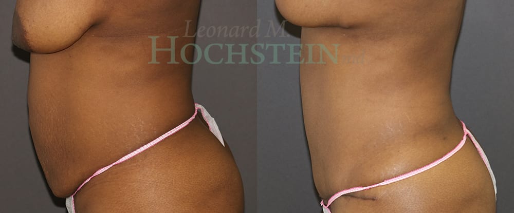 Mommy Makeover Patient