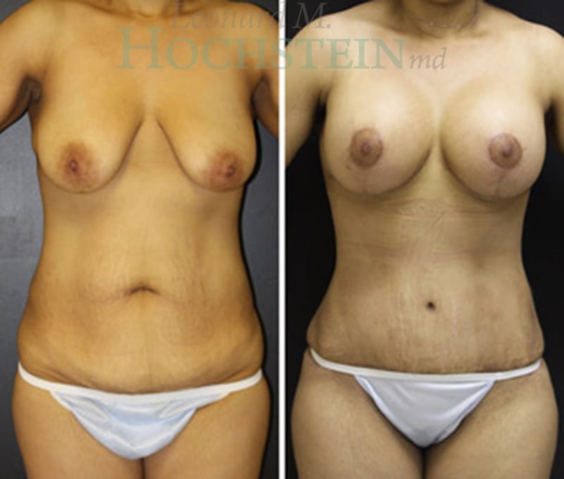 Mommy Makeover Patient