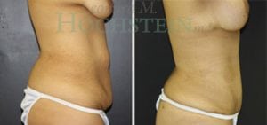 Mommy Makeover Patient