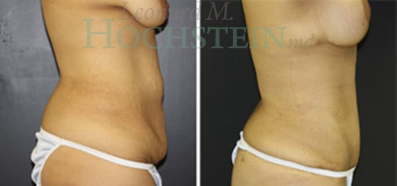 Mommy Makeover Patient