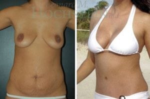 Mommy Makeover Patient