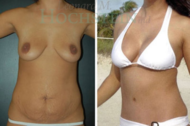 Mommy Makeover Patient