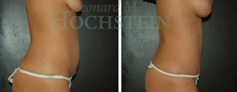 Mommy Makeover Patient