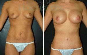 Mommy Makeover Patient