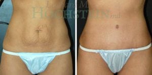 Mommy Makeover Patient