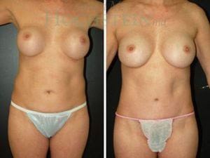 Mommy Makeover Patient