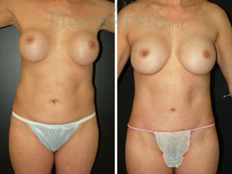 Mommy Makeover Patient