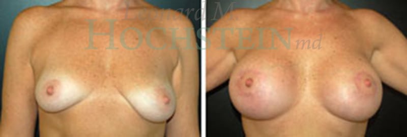 Mommy Makeover Patient