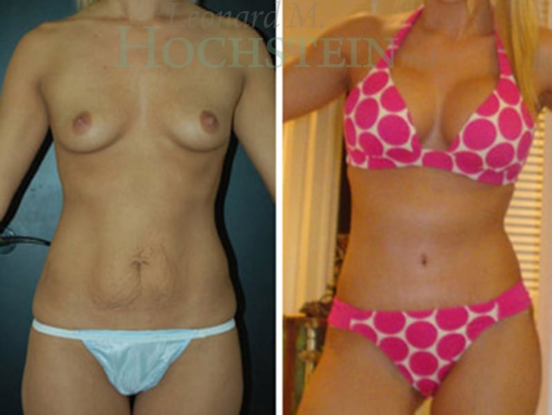 Mommy Makeover Patient