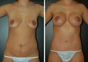 Mommy Makeover Patient