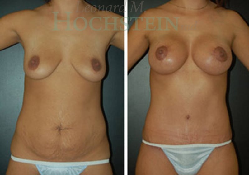 Mommy Makeover Patient