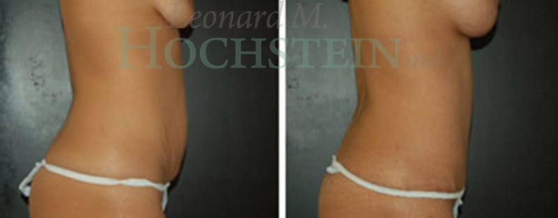 Mommy Makeover Patient