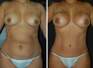 Mommy Makeover Patient