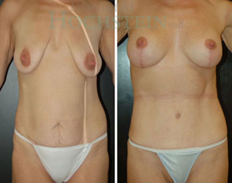 Mommy Makeover Patient