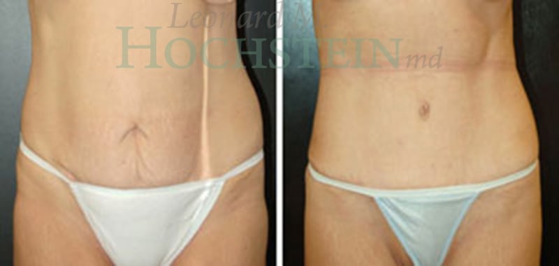 Mommy Makeover Patient