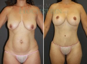 Mommy Makeover Patient