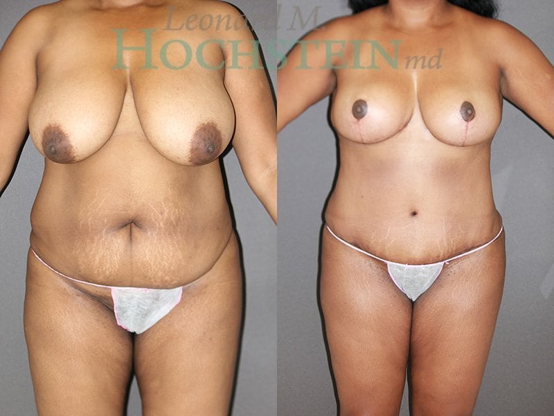 Mommy Makeover Patient