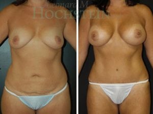 Mommy Makeover Patient