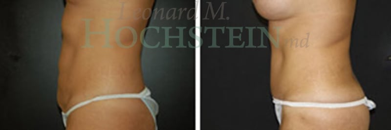 Mommy Makeover Patient