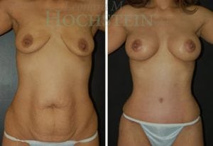 Mommy Makeover Patient