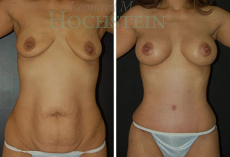Mommy Makeover Patient