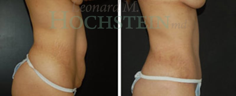 Mommy Makeover Patient