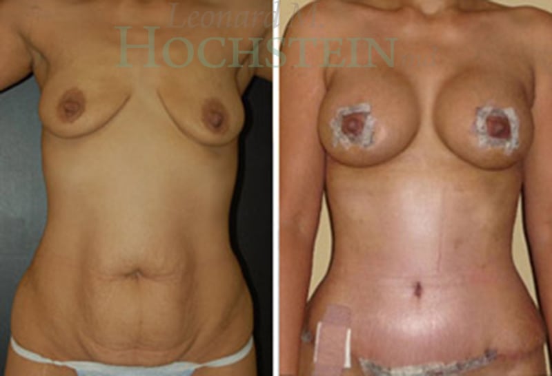 Mommy Makeover Patient