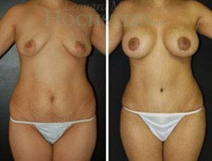 Mommy Makeover Patient