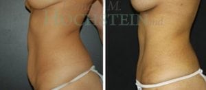 Mommy Makeover Patient