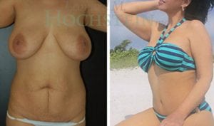 Mommy Makeover Patient 17