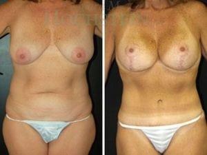 Mommy Makeover Patient