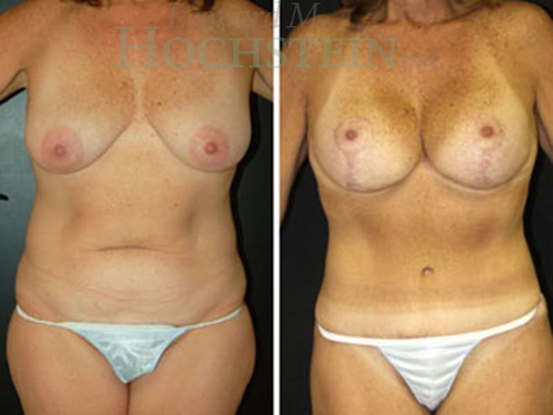 Mommy Makeover Patient