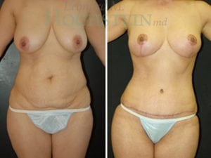 Mommy Makeover Patient