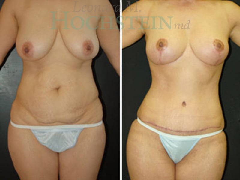 Mommy Makeover Patient