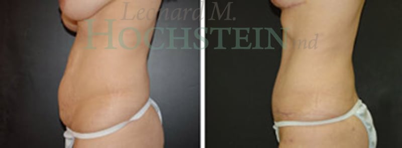 Mommy Makeover Patient