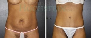 Tummy Tuck Patient