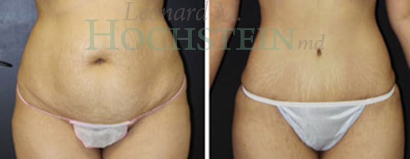 Tummy Tuck Patient