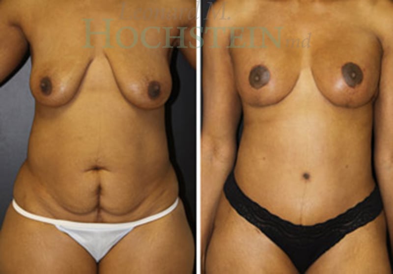 Mommy Makeover Patient